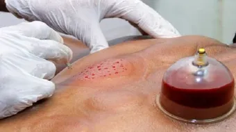 طريقة الحجامة