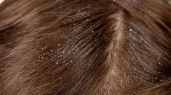 أسباب قشرة الرأس