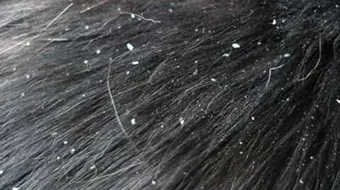 طرق التخلص من القشرة