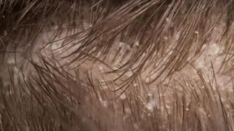 علاج قشرة الشعر