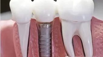 طريقة زراعة الأسنان