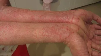 تشخيص مرض الزهري