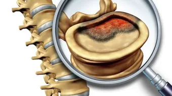 تشخيص سرطان العظام