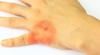 تشخيص مرض الجذام