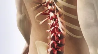 تشخيص الانزلاق الغضروفي القطني - فيديو