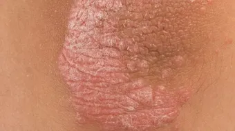 تشخيص مرض الصدفية