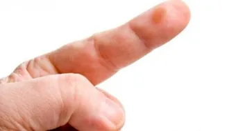 طريقة علاج الدمل