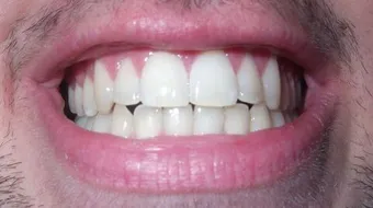 عيوب العدسات اللاصقة للأسنان