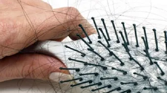 هل نقص فيتامين د يسبب تساقطاً للشعر