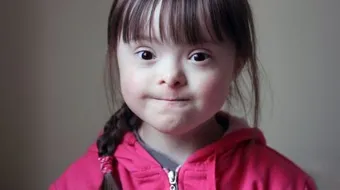 مرض متلازمة داون