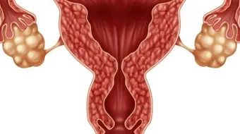 مشروب لعلاج تكيس المبايض