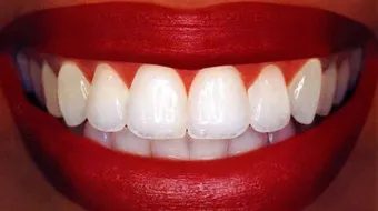 طريقة سهلة وسريعة لتبييض الأسنان