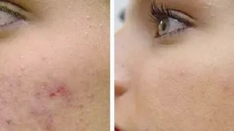 وصفات سهلة لإزالة آثار حب الشباب