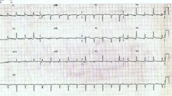 فوائد تخطيط القلب