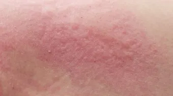 علاج الأكزيما