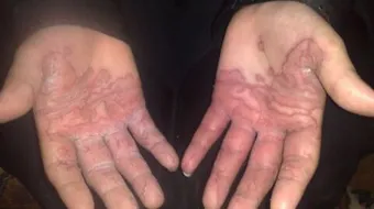 طريقة علاج الأكزيما