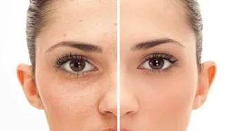 آثار حب الشباب بالوجه