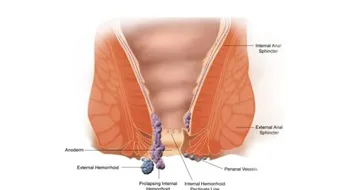 آثار البواسير