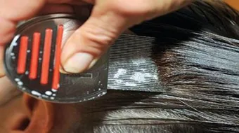 التخلص من القمل والصيبان نهائياً