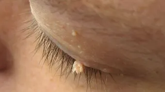 التخلص من زوائد الجلد