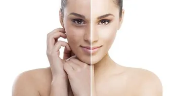 التخلص من آثار حب الشباب نهائياً