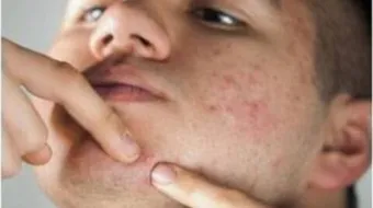 القضاء على آثار حب الشباب نهائياً