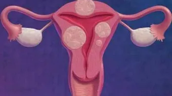 مرض بطانة الرحم المهاجرة