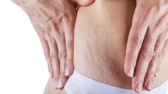 تمارين لشد ترهلات البطن بعد الولادة القيصرية