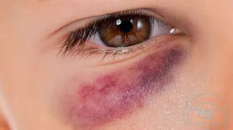 علاج كدمات العين