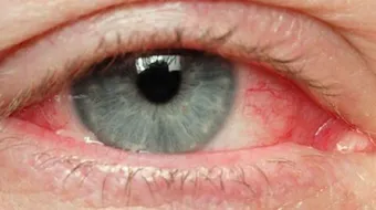 قرحة العين وكيفية علاجها