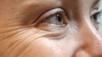 علاج تجاعيد العين