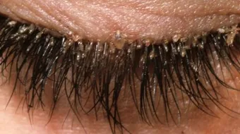 علاج قشرة الرموش