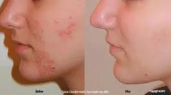 طرق تصفية الوجه