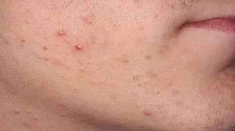 علاج حبوب الوجه