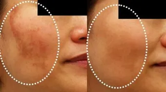 طرق علاج الكلف في الوجه