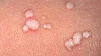 علاج الثالول بالوجه