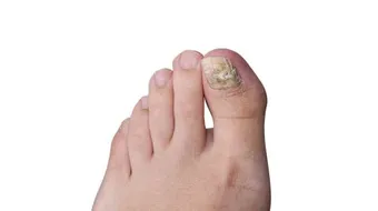 تحسس العفن أو الفطريات