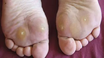 مرض عين السمكة