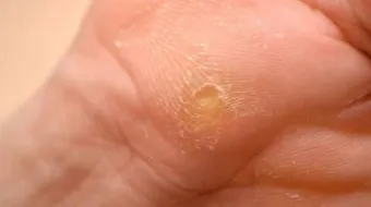 علاج عين السمكة في القدم