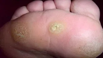 علاج عين السمكة