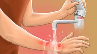 لعلاج الحروق