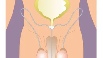 الخصية الهاربة