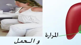 حصوة المرارة والحمل
