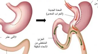 طريقة غسيل المعدة