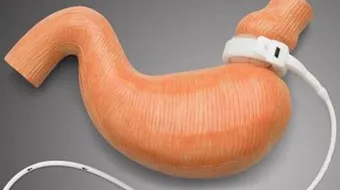 عملية تصغير المعدة