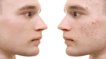 التخلص من حب الشباب وآثاره في أسبوع