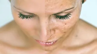 التخلص من البقع السوداء في الوجه