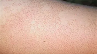 التخلص من جلد الوزة