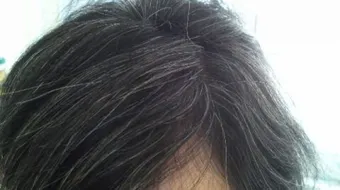 التخلص من الشيب المبكر