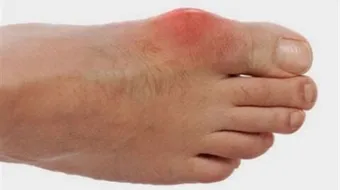 النقرس ومشاكل الكلى